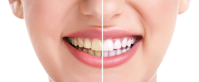 tooth whitening hove